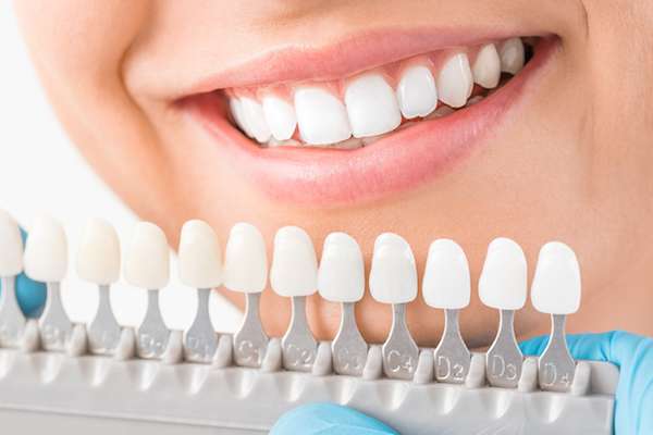Ask A Cosmetic Dentist: What Are Veneers