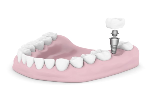 Dental Implant To Replace Single Missing Tooth